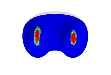 Wear Simulator: Predict wear on the tibial insert over a number of gait cycles using the Wear Simulator in the Abaqus Knee Simulator. 